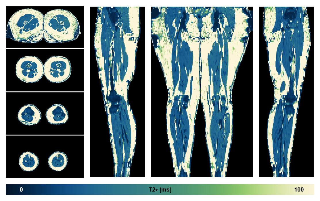 The T2 star relaxation time of the lower extremity obtained from the dixon reconstruction for muscle water fat quantification.